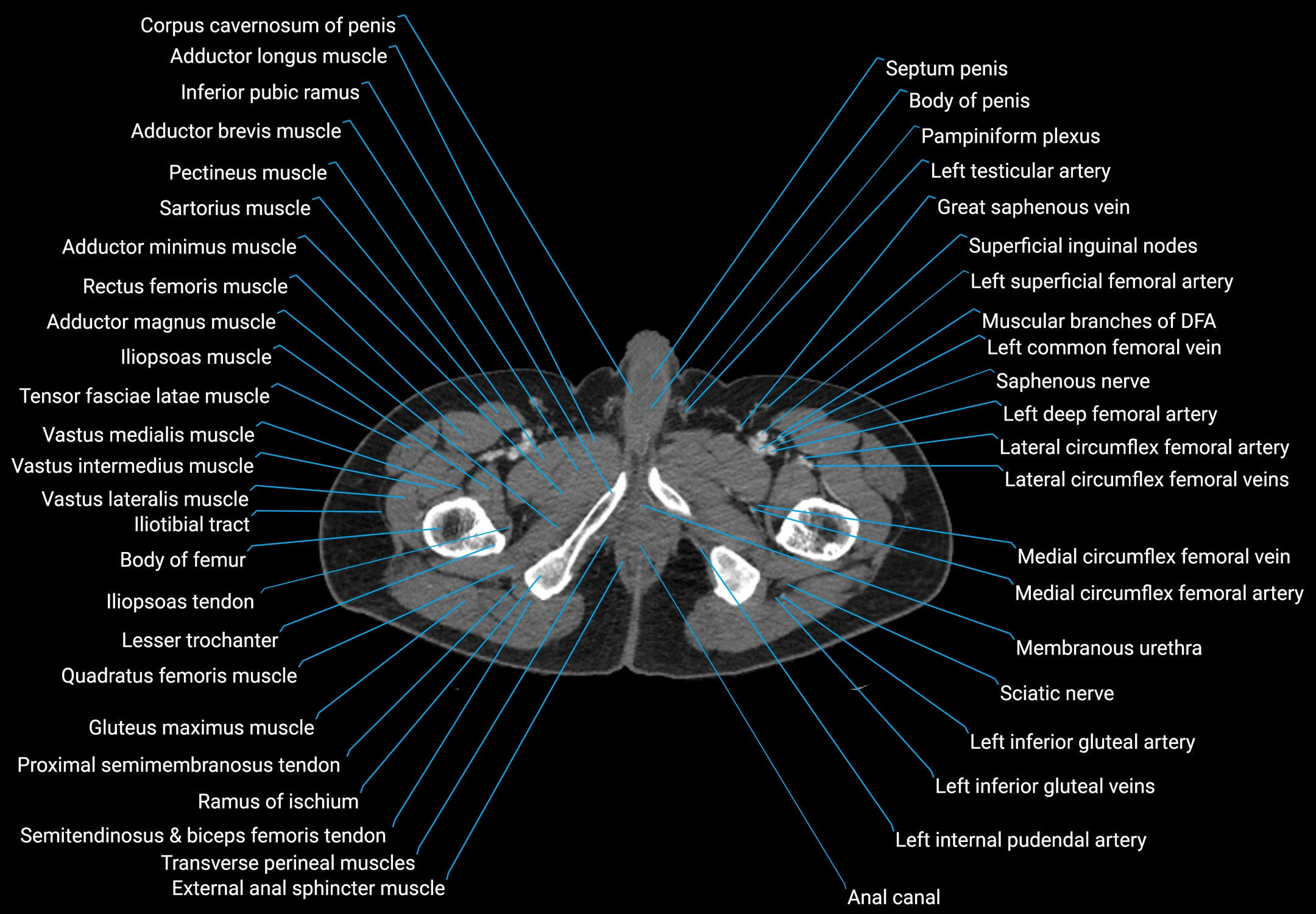 CT male pelvis axial cross sectional anatomy labelled radiology image -00211.webp